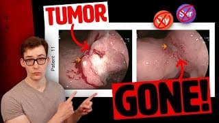 Restricting 2 Amino Acids eliminated Cancer in Clinical Trial!